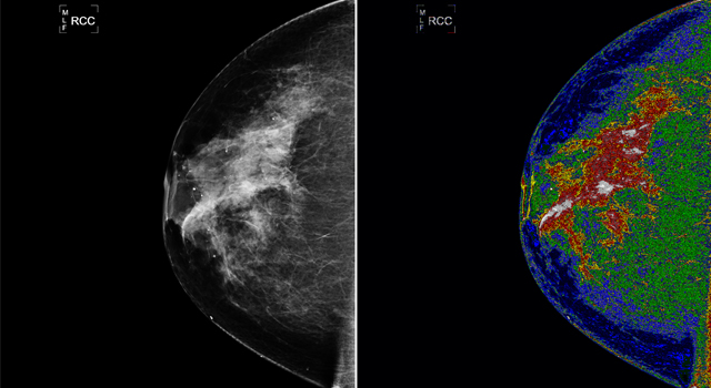 Tomosynthesis   3d mammography  x ray imaging   3 d 